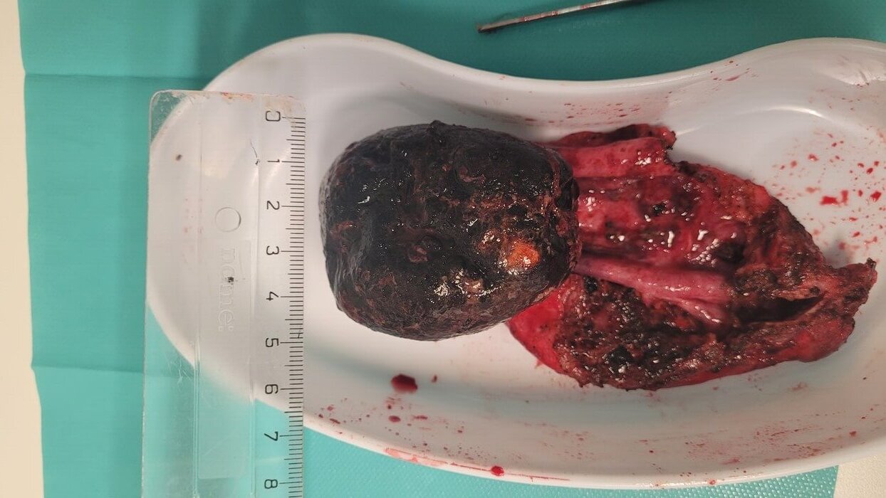 How large can a gallstone be?